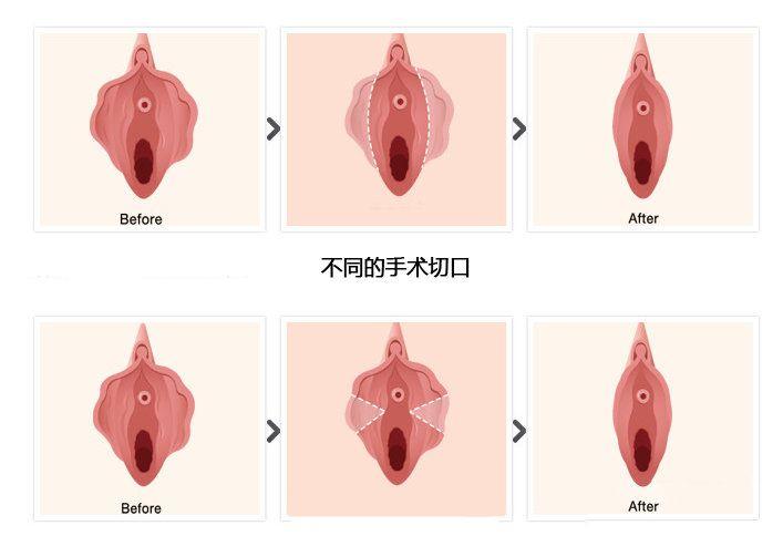 女人私密整形图片的对比
