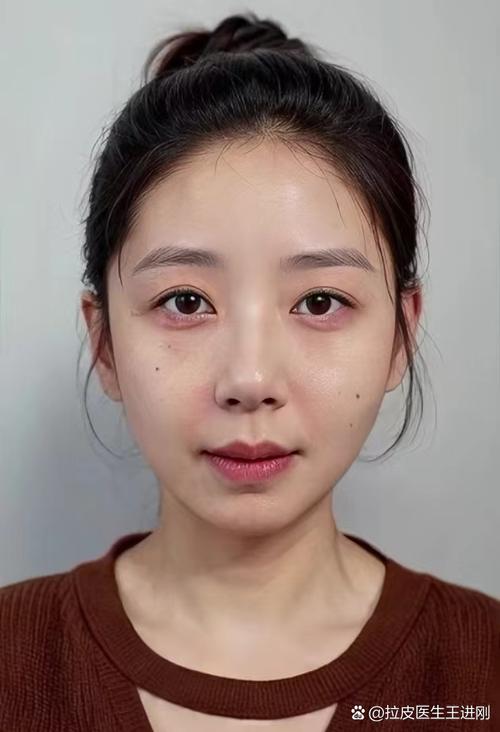 淮南市彩光脱唇毛医生排名top10名气名单推荐 崔启荣医生技术实力优异 淮南市彩光脱唇毛医生排名top10名气名单推荐 崔启荣医生技术实力优异