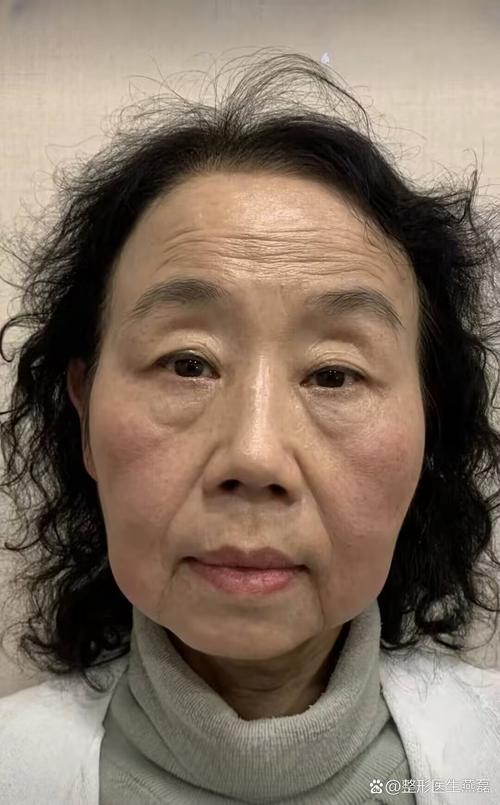 中国plasma修复痘坑医院排行榜 plasma修复痘坑医院前50位公测 中国plasma修复痘坑医院排行榜 plasma修复痘坑医院前50位公测